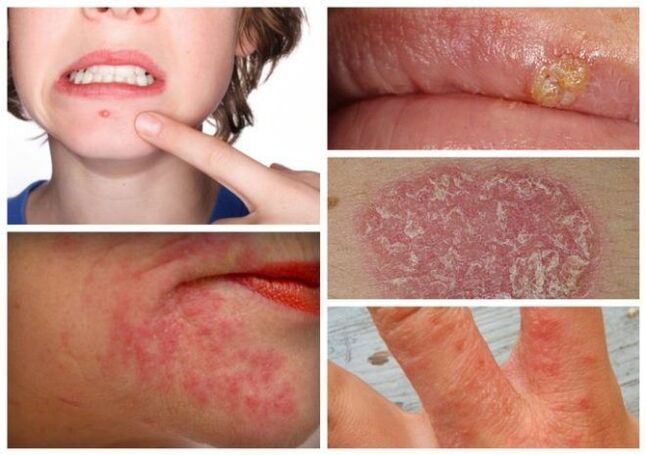 Allergien und Hautkrankheiten sind Anzeichen von Parasiten im Körper. 