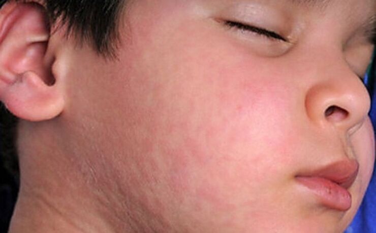 Allergische Hautausschläge sind ein Symptom für das Vorhandensein parasitärer Würmer im Körper